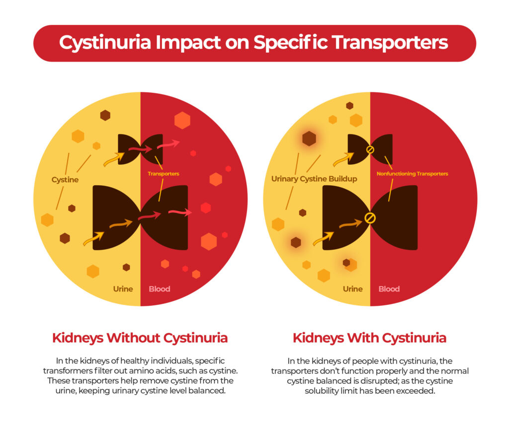 Cystinuria Impact on Specific Transporters